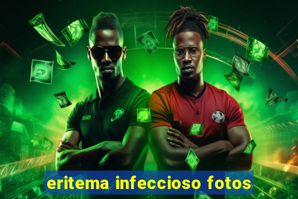 eritema infeccioso fotos